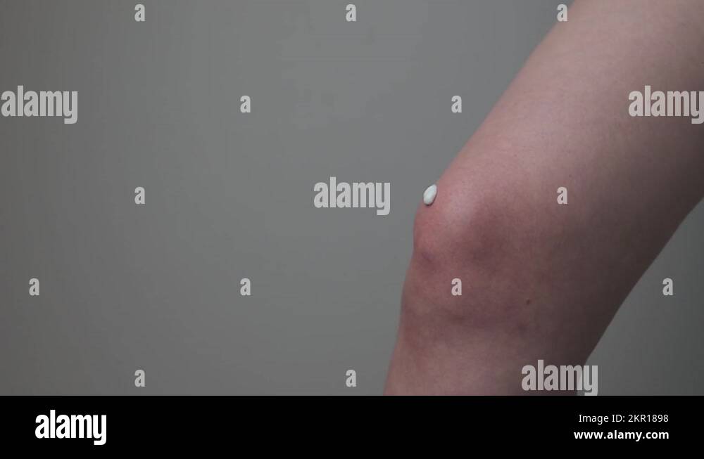 Apllying pain relief cream, ointment on knee, joint close up. Treating leg part Stock Video