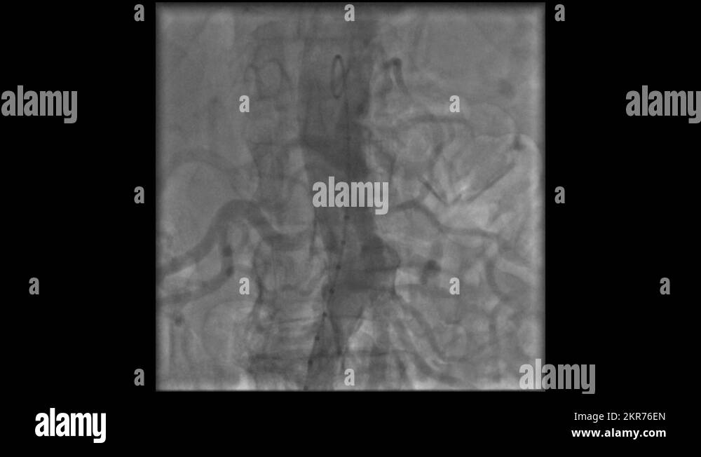 Artery blockage Stock Videos & Footage HD and 4K Video Clips Alamy