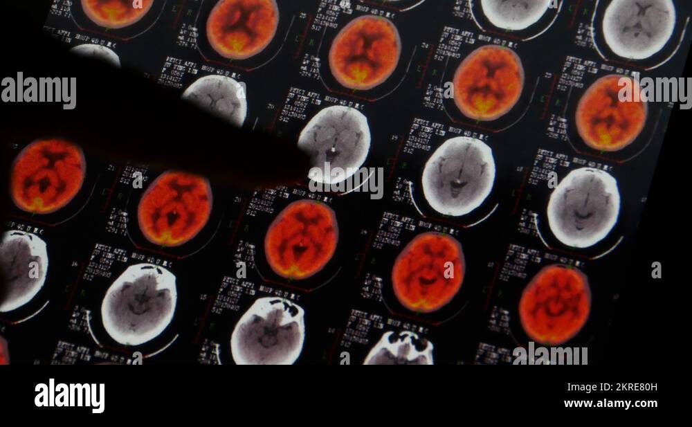 4k Doctors study head pet-ct skull brain scan X-ray film for analysis ...
