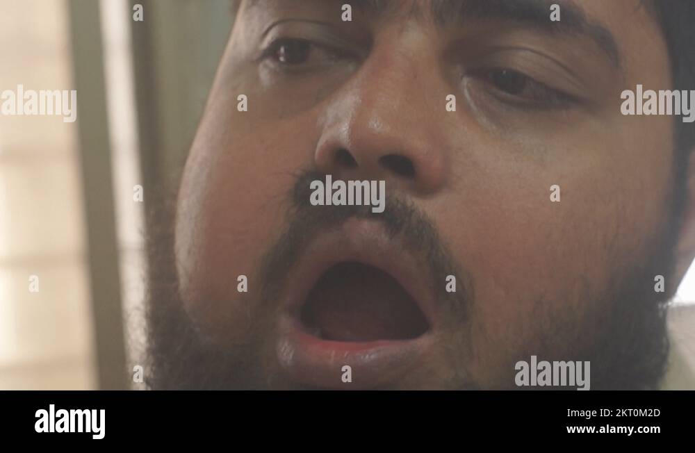 Oral Cancer Patient cant open his mouth fully Stock Video Footage Alamy