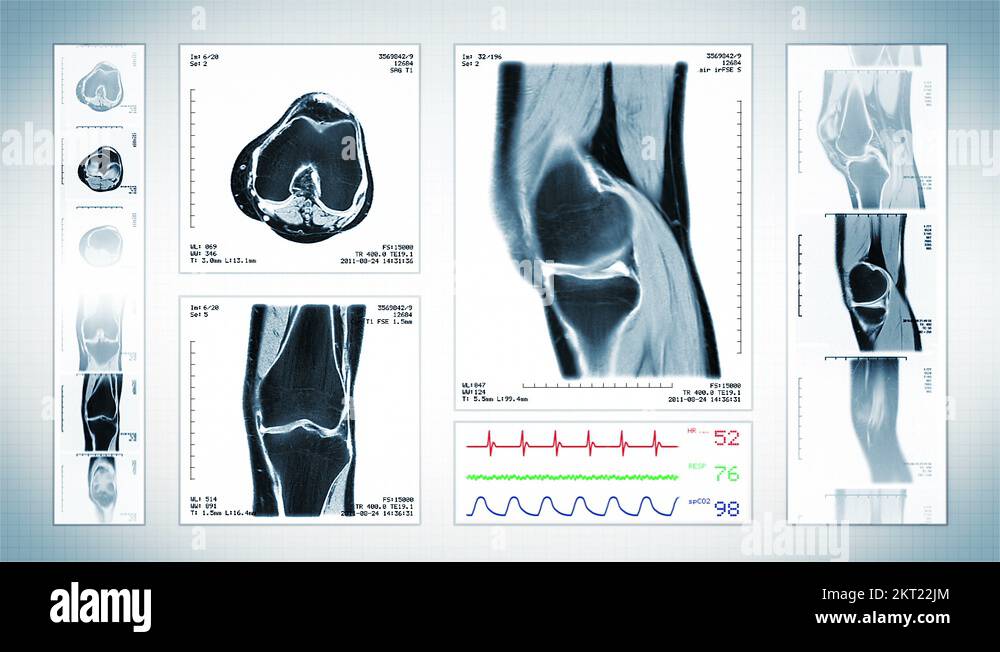 Knee mri Stock Videos & Footage - HD and 4K Video Clips - Alamy