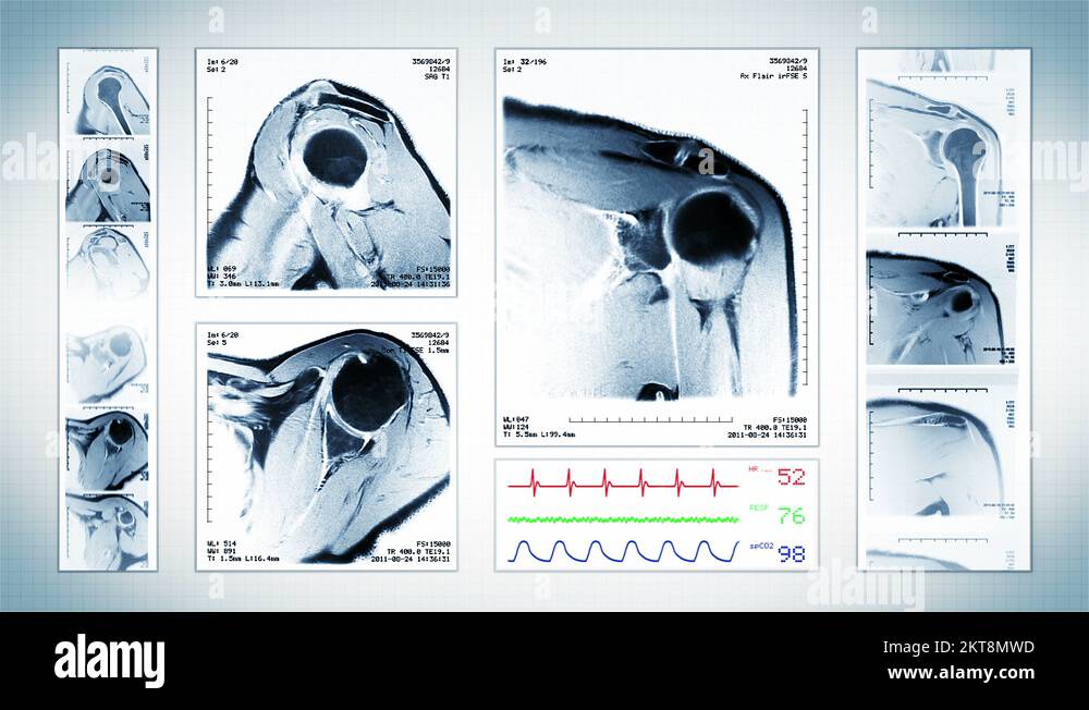 Shoulder MRI Scan. White. 4 in 1. Top, front, lateral view. ECG display