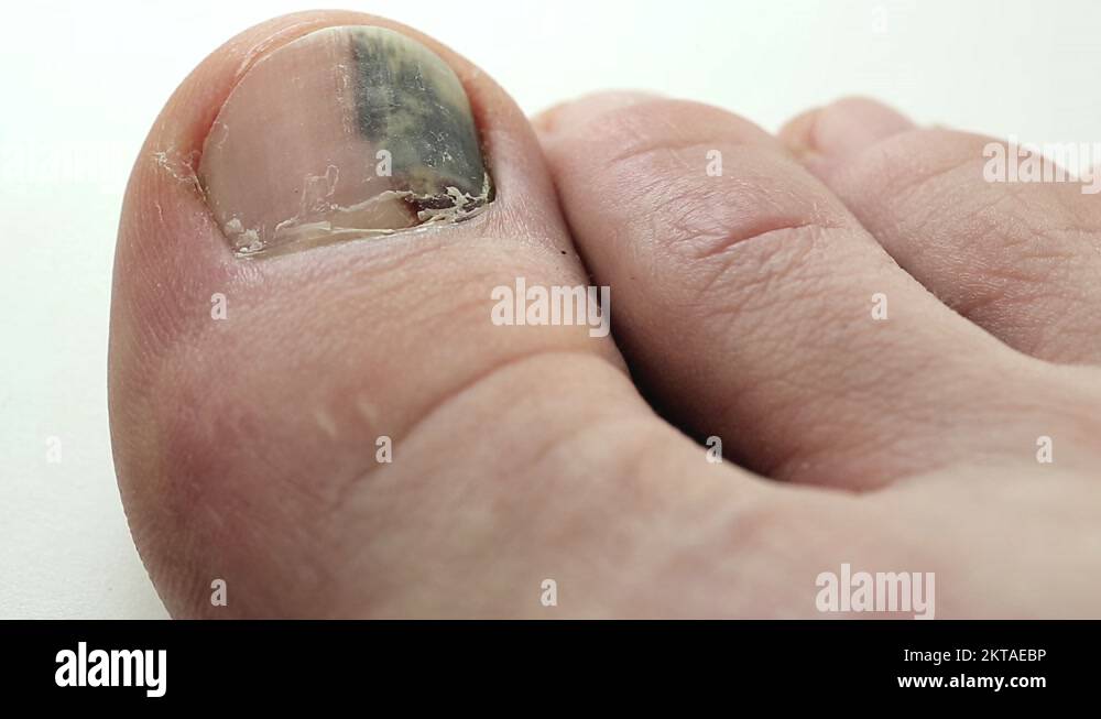 Trauma of toenail. Subungual hematoma Stock Video Footage Alamy