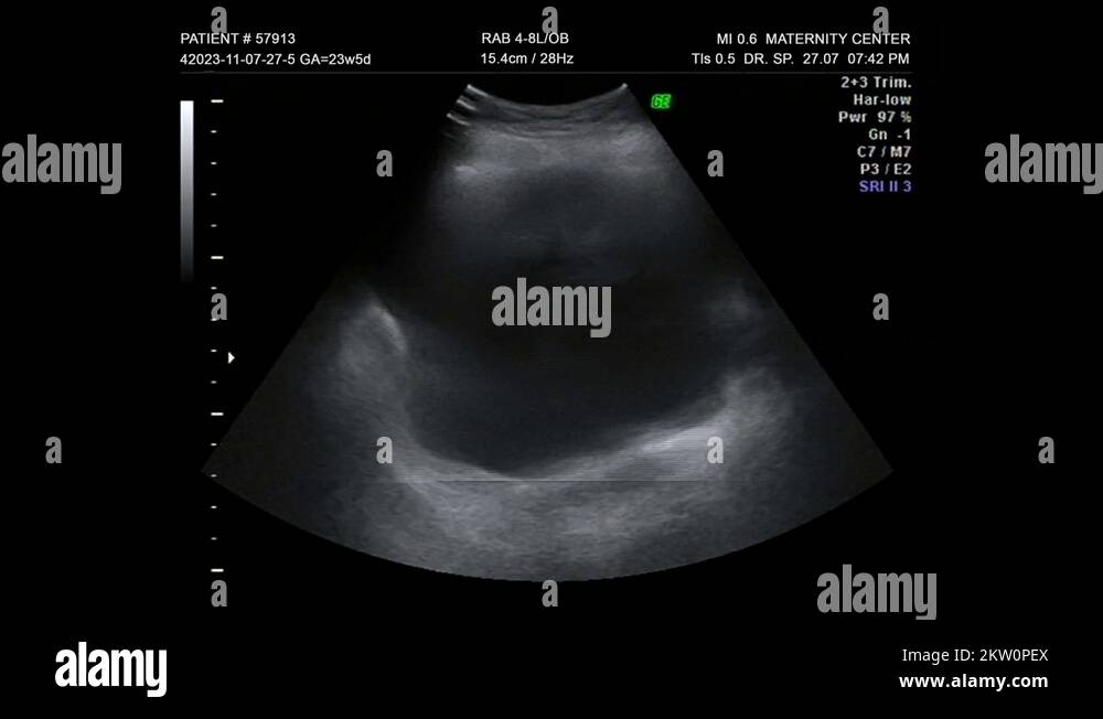 Ultrasound pregnancy Stock Videos & Footage - HD and 4K Video Clips - Alamy