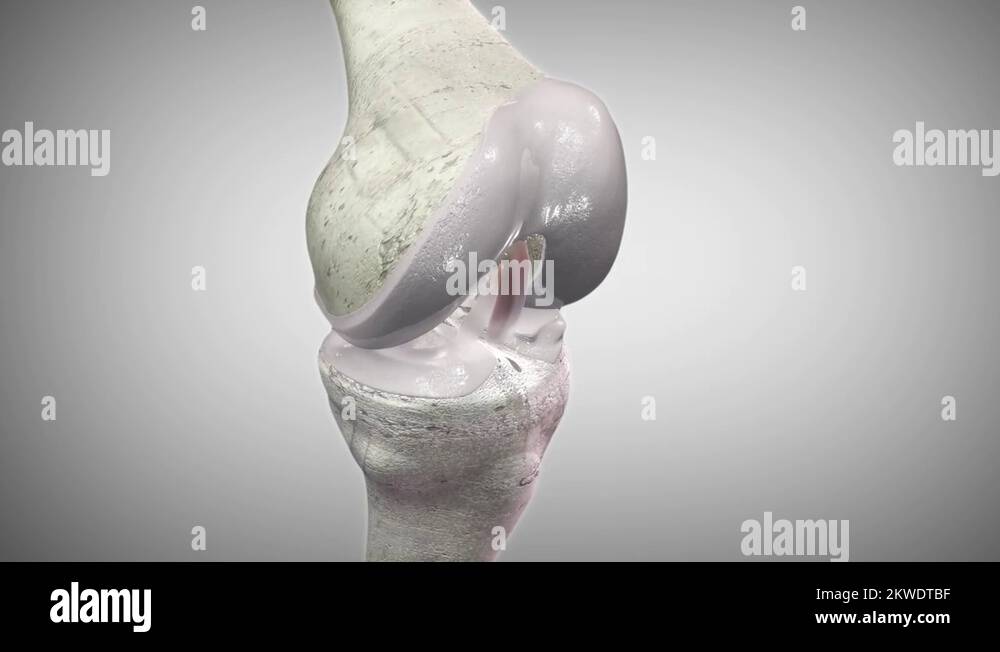 Knee joint arthritis Stock Videos & Footage HD and 4K Video Clips Alamy