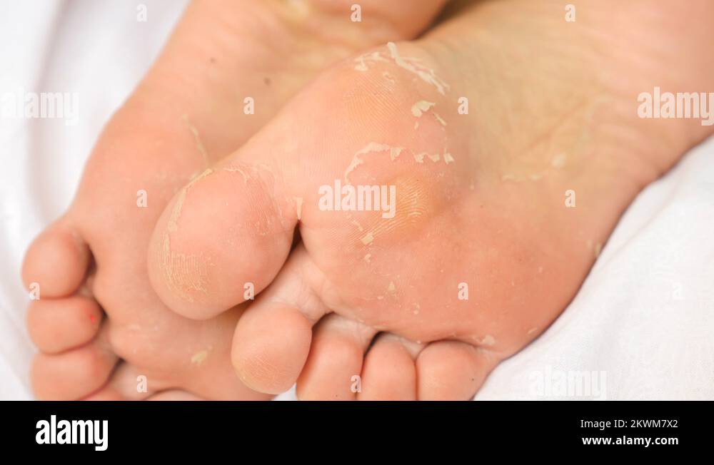 Female feet with skin peeling off. Foot peeling after the procedure. 4k
