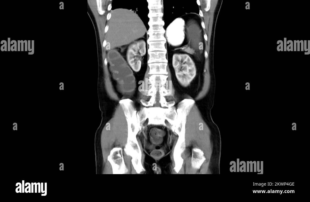 Abdominal ct scan abdomen Stock Videos & Footage - HD and 4K Video ...