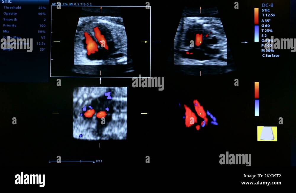 Colourful footage of pregnancy ultrasound monitor Stock Video Footage