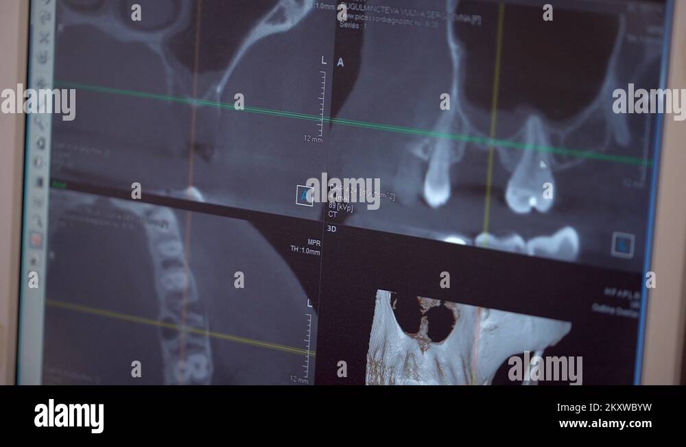 Dental X ray with bad teeth. dentist examining xray report on computer