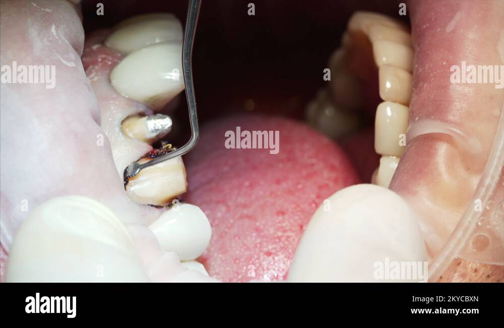 What Happens If Dental Cord Is Left In at Maria Woodson blog