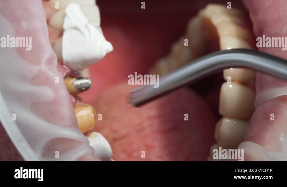 Close view orthodontist dries glue on teeth before dental crowning