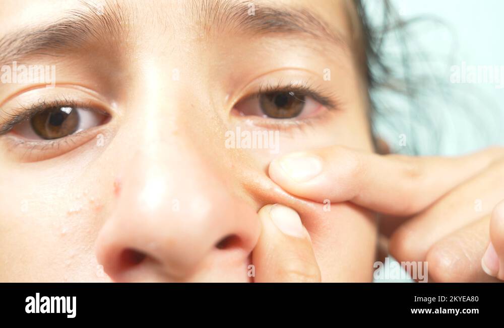 Girl squeezing a spot Stock Videos & Footage HD and 4K Video Clips