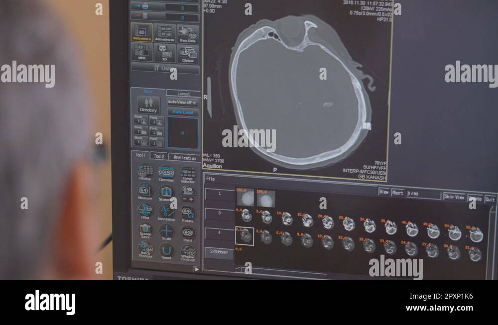 Unrecognizable Doctor examines a head MRI scan on a computer screen ...