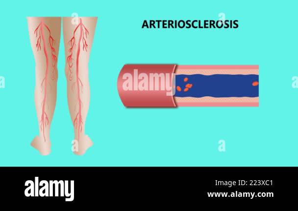 Compressing A Balloon Angioplasty. Stent Implantation. Deflated balloon catheter inserted ...