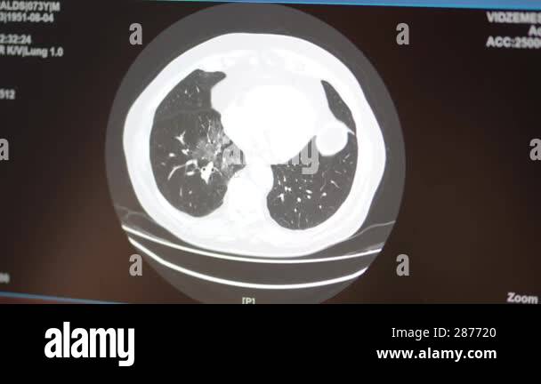 Valmiera Latvia January 18 2025 CT Scan Of The Chest Showing Lung Valmiera Latvia January 18 2025 Ct Scan Of The Chest Showing Lung Anatomy And Internal Structures Displayed On A Medical Imaging Screen For Diagnostic Purposes 2s87720