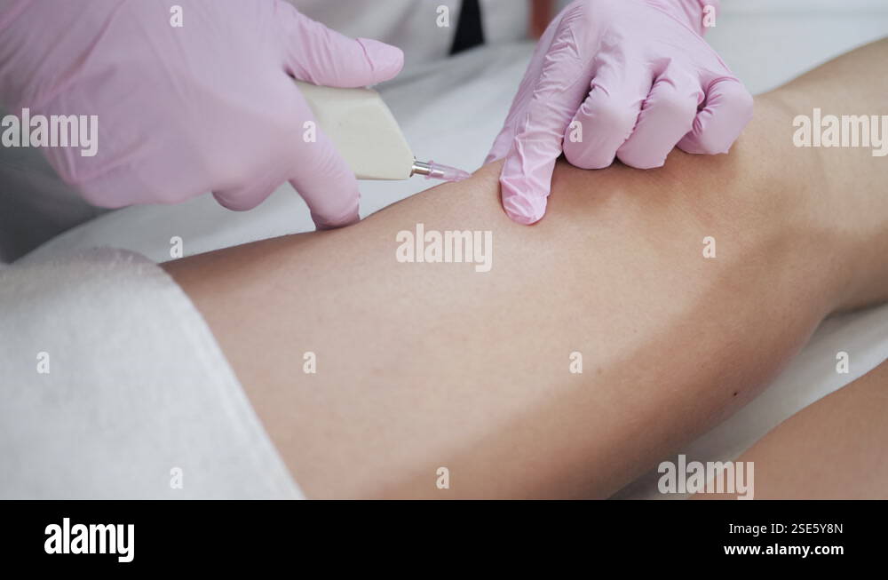 Doctor is making injection of carbon dioxide in patient's leg on ...