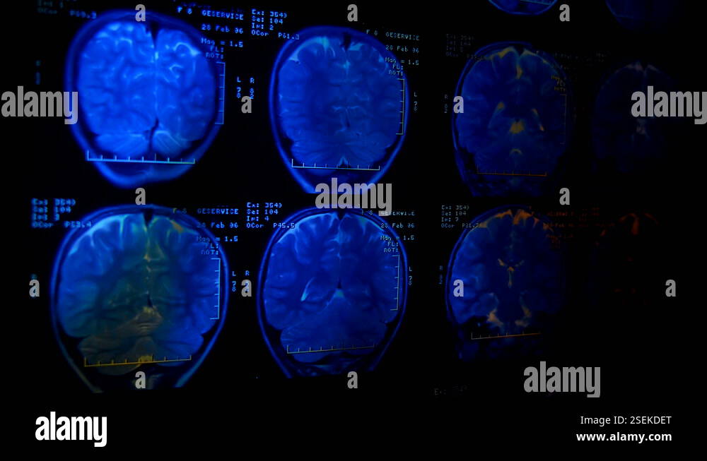 Magnetic resonance imaging (mri) of the human brain. Closeup. Macro ...