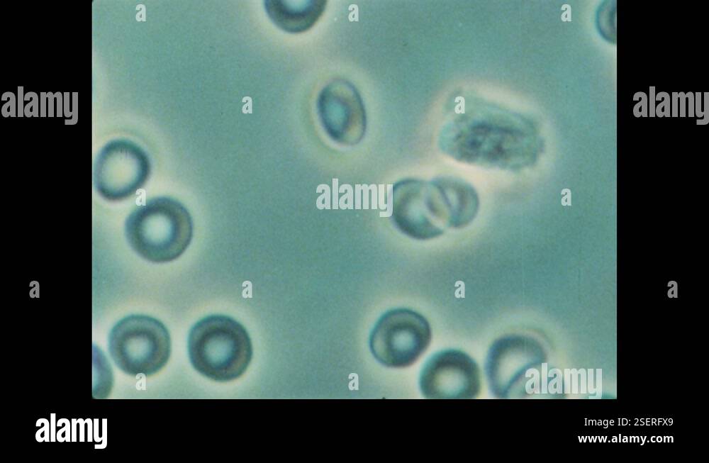 Blood Float 1970s: Red blood cells float around a white blood cell. White blood ...