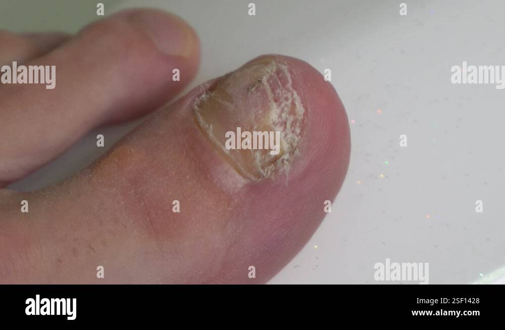 Crystal Toe Yellow cracked and discolored toe nail caused by mycosis - fingers rub ...