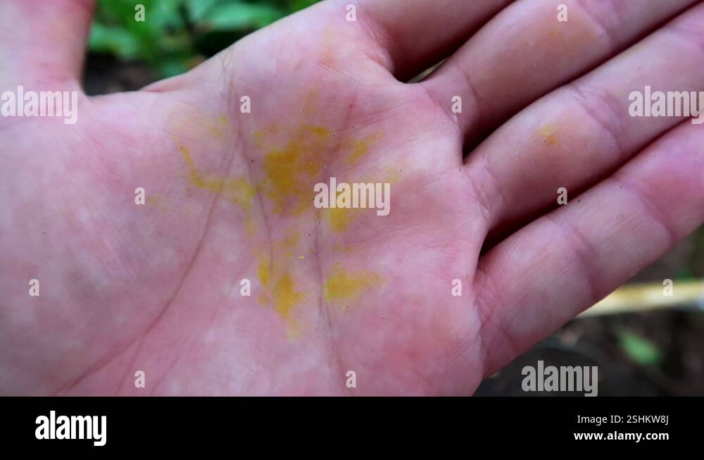Yellow discoloration Stock Videos & Footage - HD and 4K Video Clips - Alamy