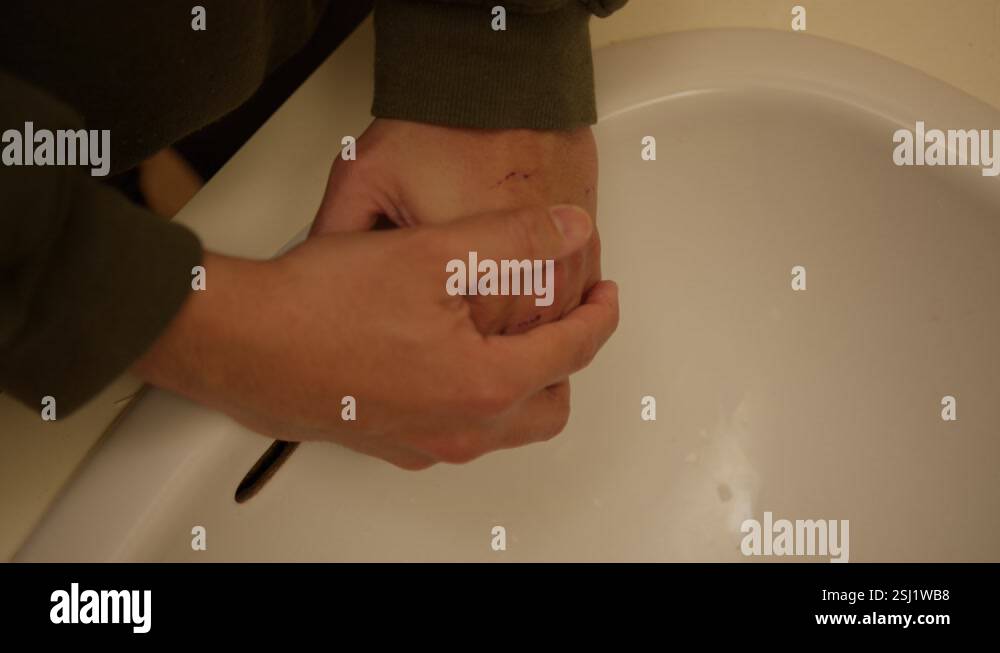 Injured man with scratches on one hand rubbing the hand at the washroom ...