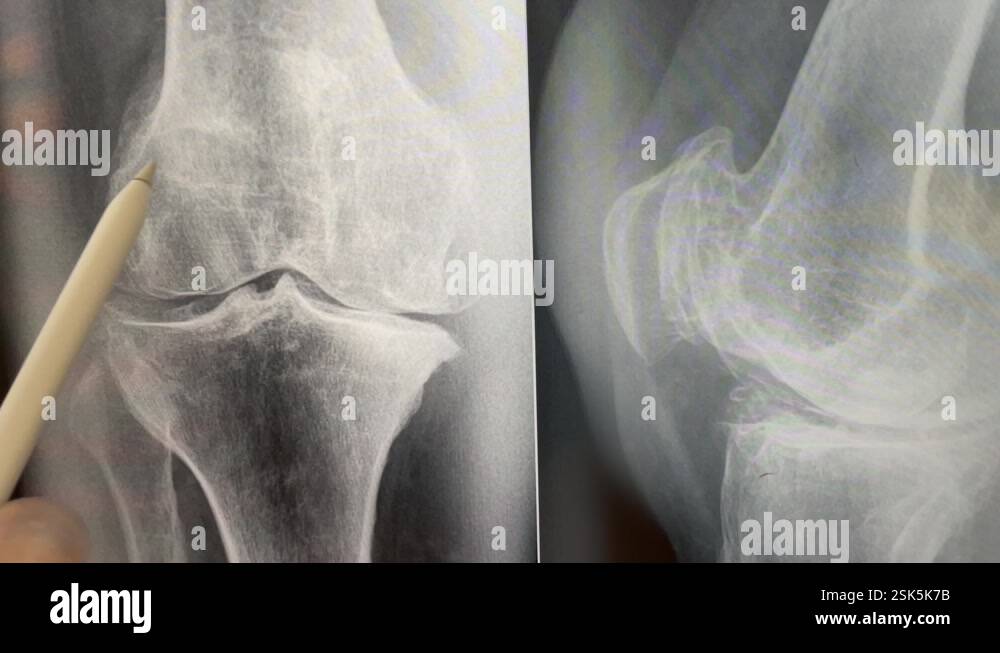 Plain X ray of the knee shows apparent joint osteoarthritis Stock Video ...