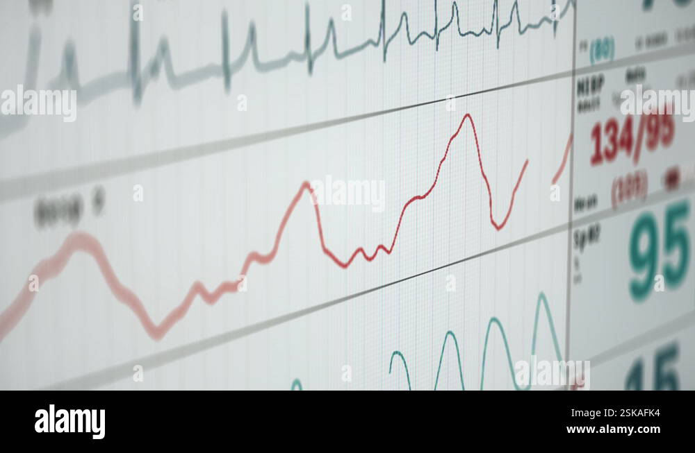 Monitoring equipment displaying the healthy pulse graph of the ...