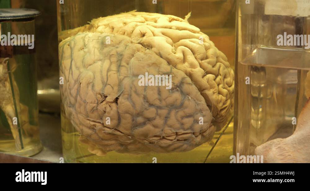 Real human brain. Anatomy of brain, grey substance, grey matter ...