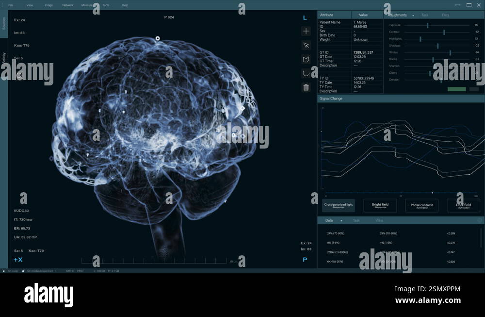 VFX Interface Of Medical Software With Brain Scan Stock Video Footage ...