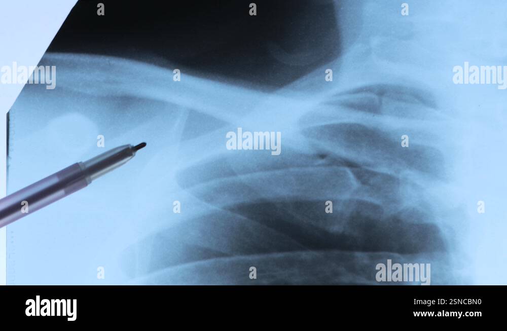 Dislocation X Ray Scan X-ray scan of Dislocation of the acromial end of the clavicle Stock ...