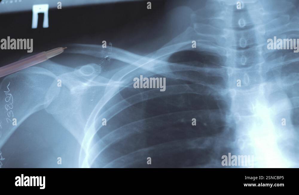 Dislocation X Ray Scan Doctor examining X-ray scan of Dislocation of the acromial Stock Video ...