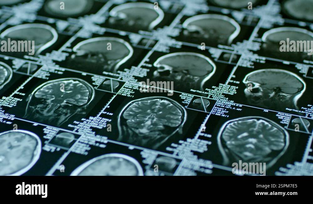 CT Scan of Human Brain Stock Video Footage - Alamy