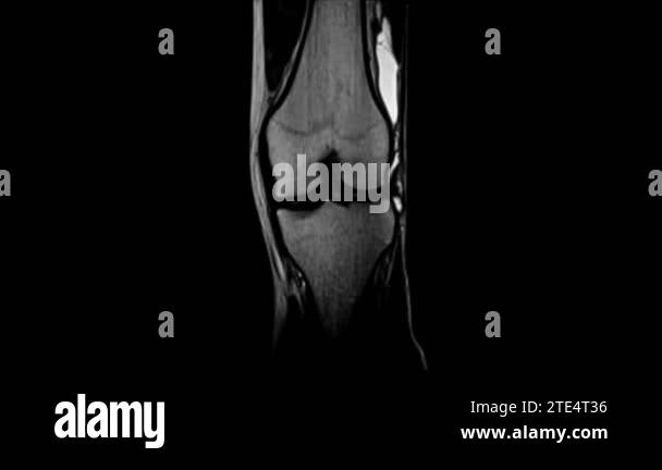 MRI of the knee joint, x-ray Stock Video Footage - Alamy