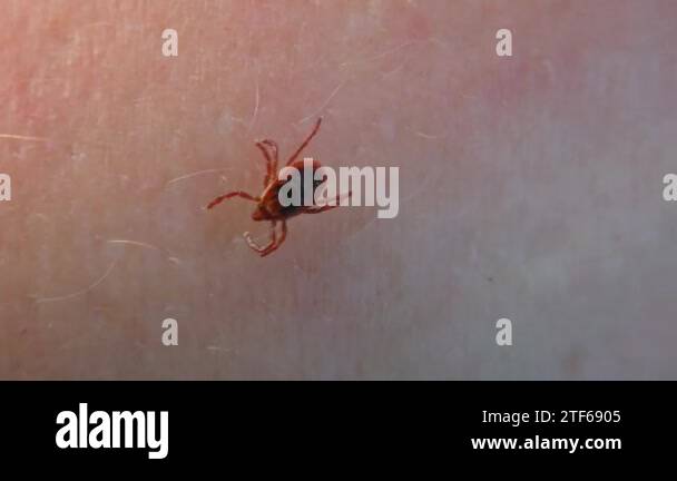 Dangerous vector Scale tick on human skin Stock Video Footage - Alamy