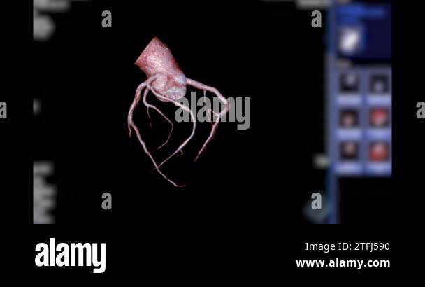 CTA Coronary artery 3D rendering turn around on the screen for ...