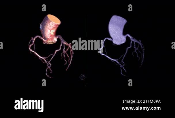CTA Coronary artery 3D rendering turn around on the screen for ...
