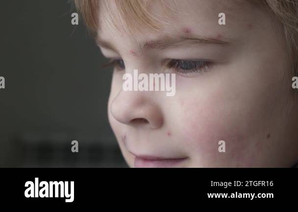 Close-up Kid Face Covered with Rash of Itchy Inflamed Blisters ...