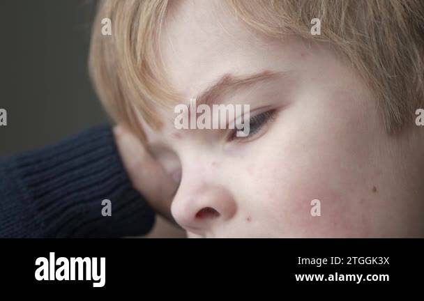 Close-up Kid Face Covered with Rash of Itchy Inflamed Blisters ...