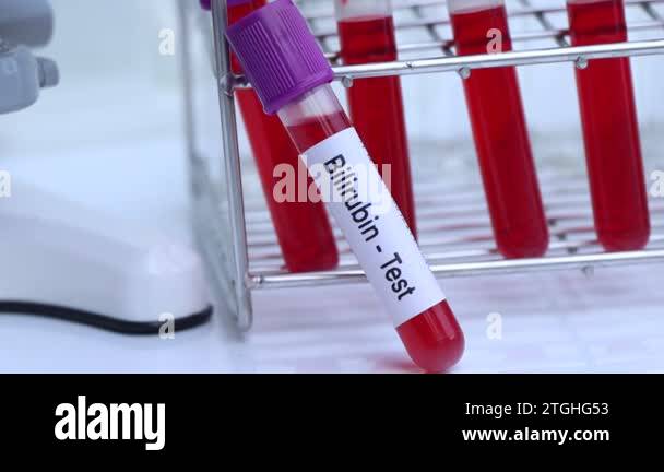Bilirubin test to look for abnormalities from blood, blood sample to ...