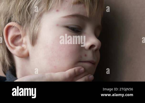 Close-up Kid Face Covered with Rash of Itchy Inflamed Blisters ...
