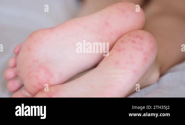 Allergic Rash Feet Feet of child with red allergic spots dots on foot. Enterovirus ...