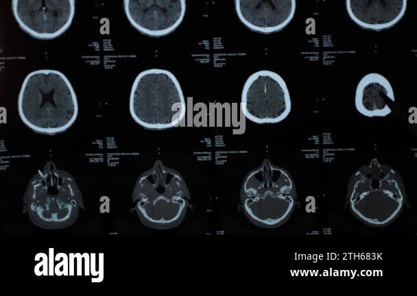 Traumatic brain injury mri Stock Videos & Footage - HD and 4K Video