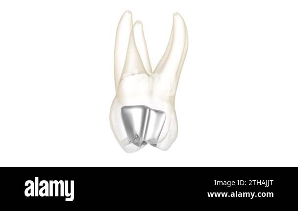 Tooth Defects Animation Amalgam and tooth destruction. Medically accurate 3D animation of ...
