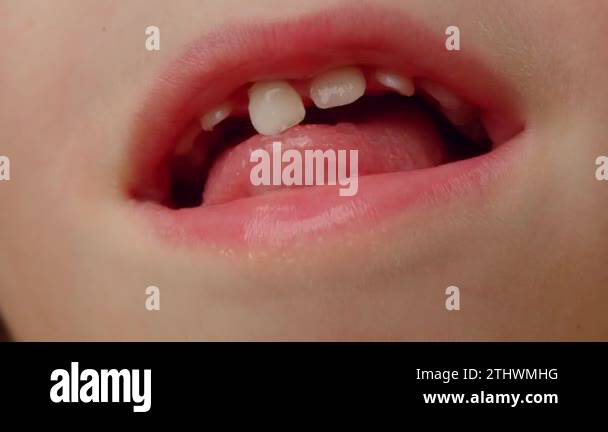 Close-up childs mouth pulling out milk tooth. Change of teeth. Loss of