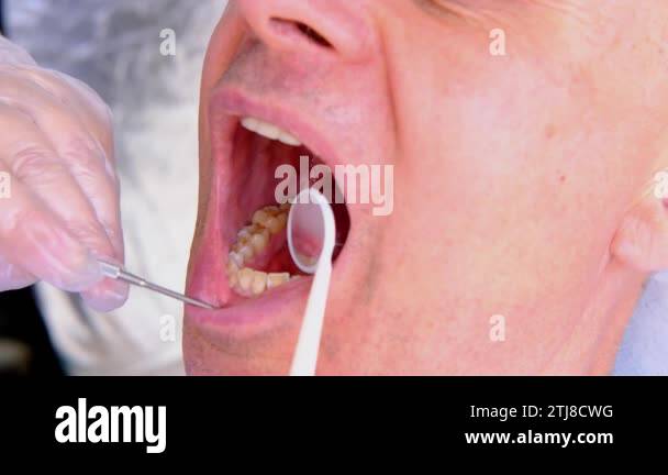 Closeup open mouth dental tools Stock Videos & Footage - HD and 4K ...