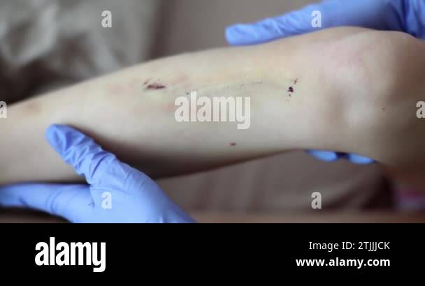 Knee injury bruise on leg Stock Videos & Footage - HD and 4K Video ...