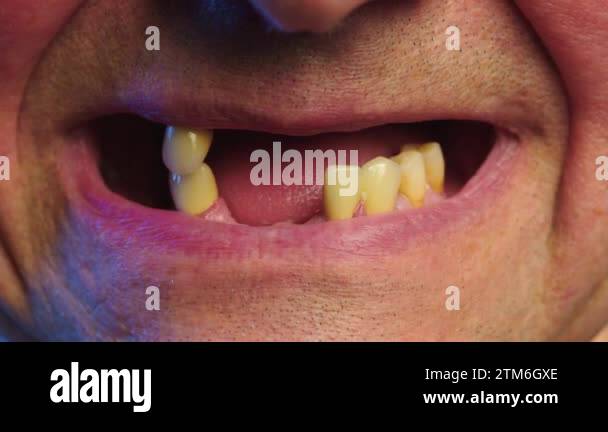Periodontal disease and missing teeth in an elderly man. Close up shot