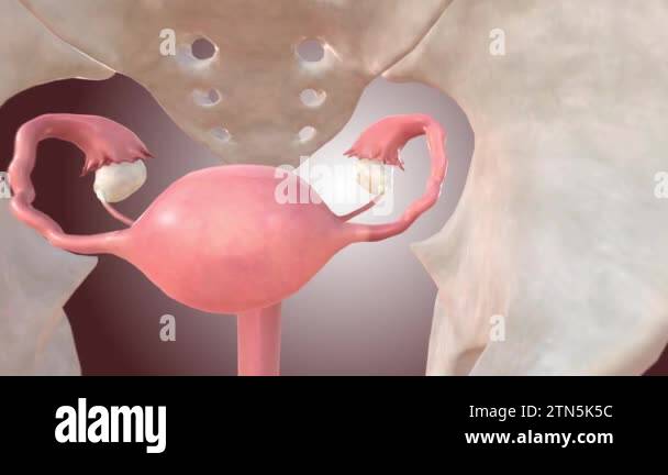 Fallopian Tube Rupturing Ruptured Fallopian Tube 3d medical Stock Video Footage - Alamy