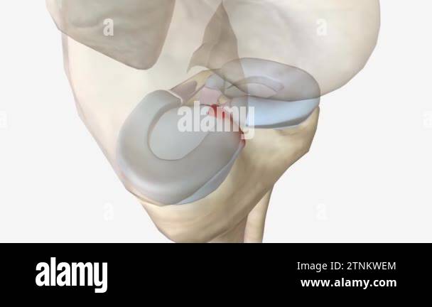 Meniscal root tears are less common than meniscal body tears and ...