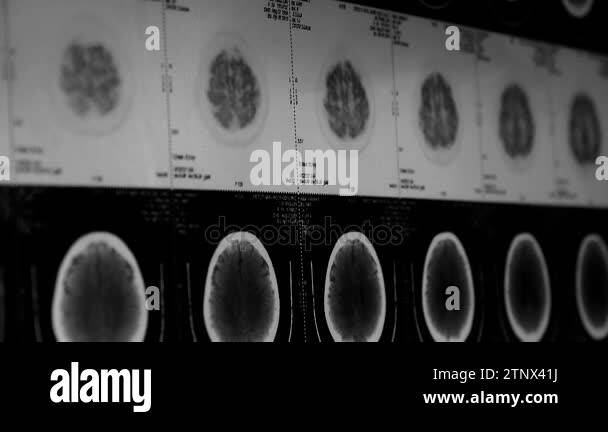 China-Sep 08,2017:moving head pet cT scan,skull brain X-ray Stock Video ...
